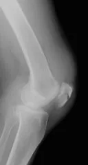 骨折編 膝蓋骨の骨折 むつみクリニック